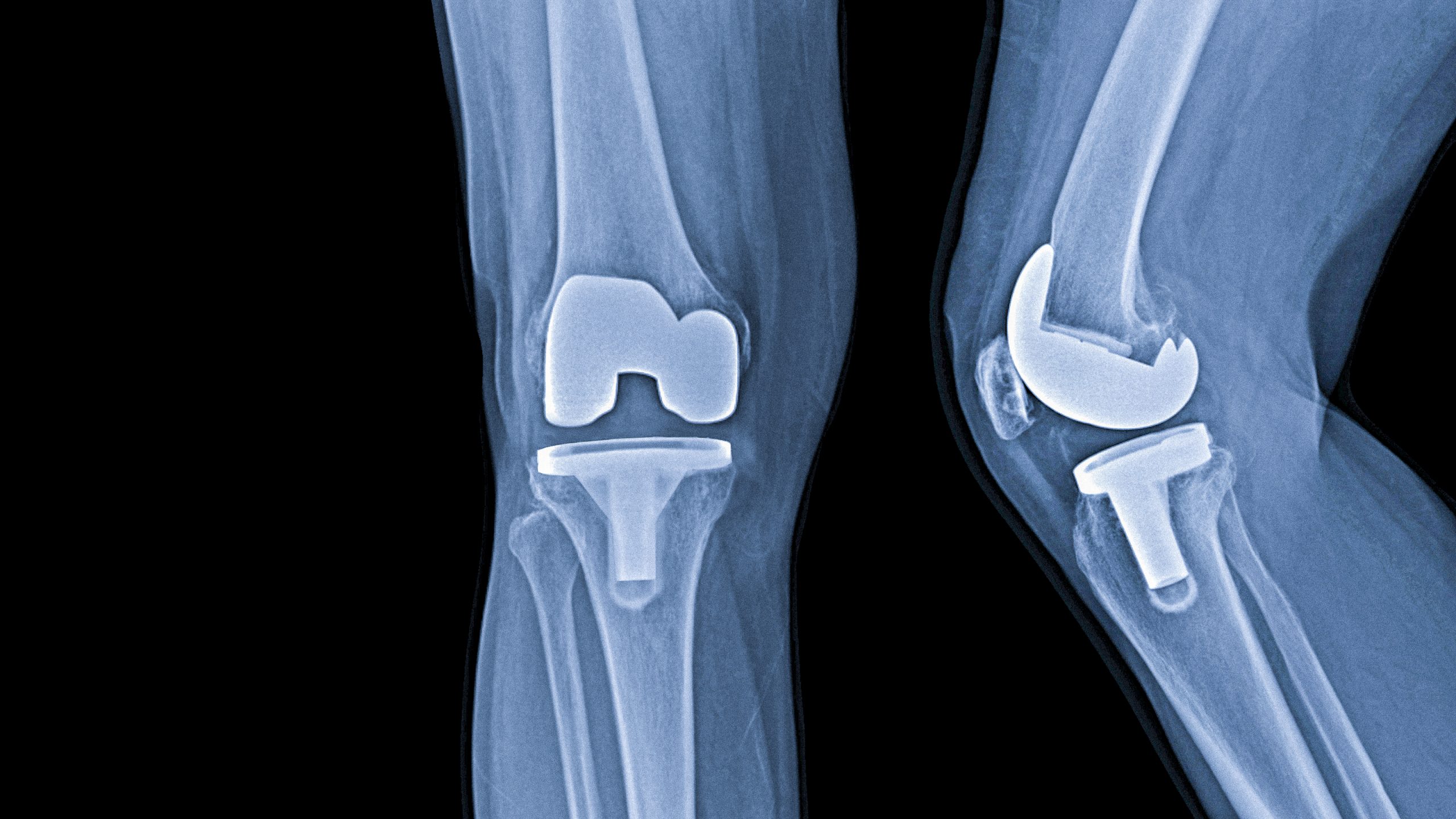 Künstliches Knie mit Knie-Gelenkersatz